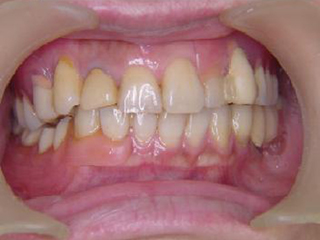 入れ歯 入れ歯