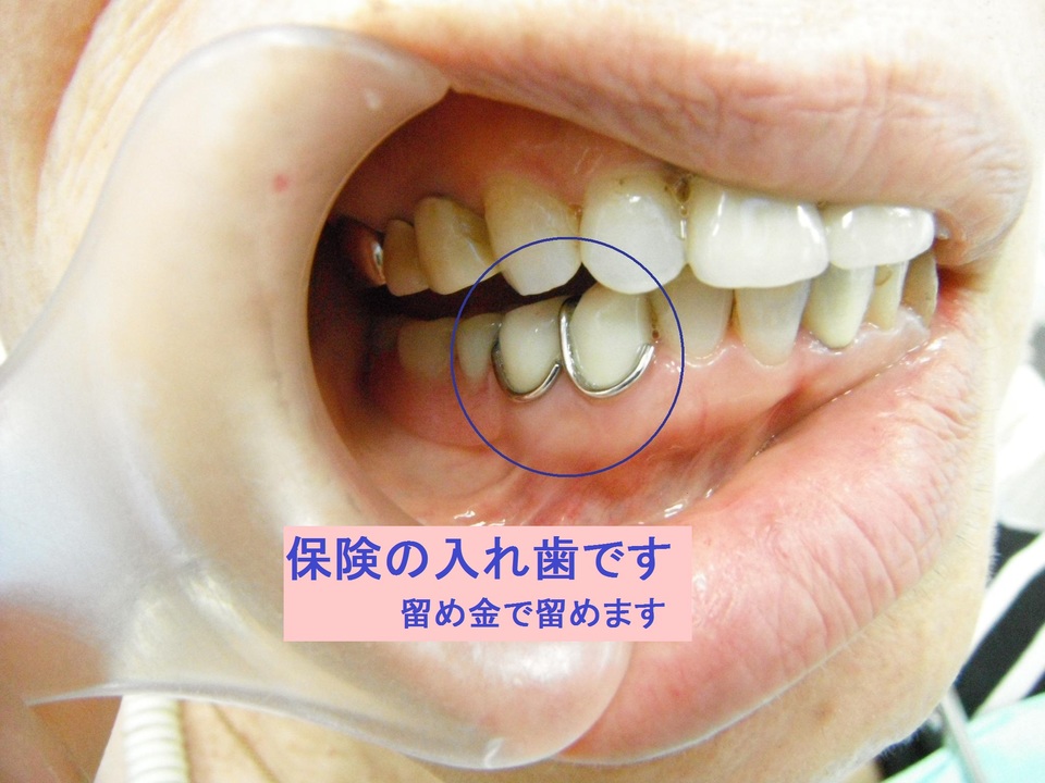 入れ歯 入れ歯